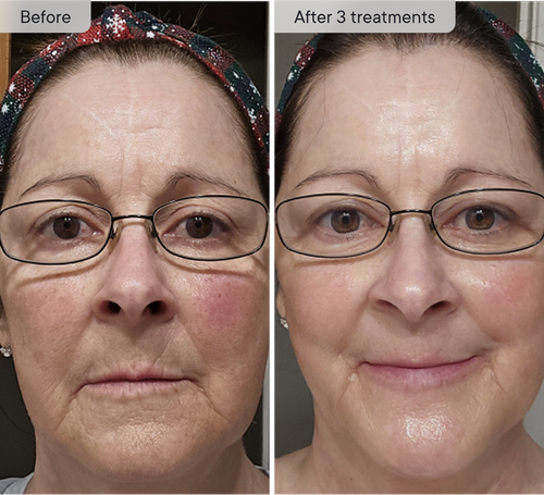 Refresh the look of dull skin with the Micro-Infusion Facial System