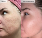 Refresh the look of dull skin with the Micro-Infusion Facial System